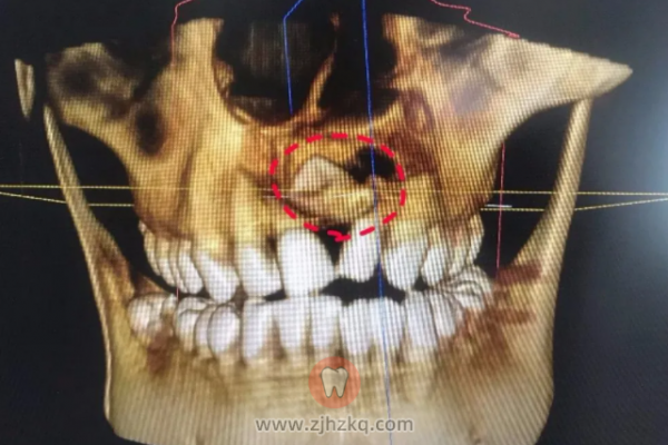 杭州儿童多生牙是不是一定要拔？