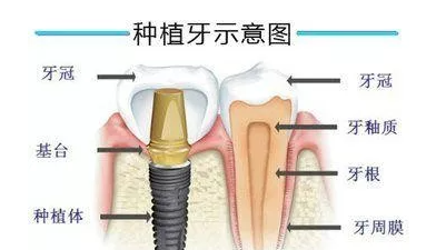 杭州种植牙为什么要那么贵？