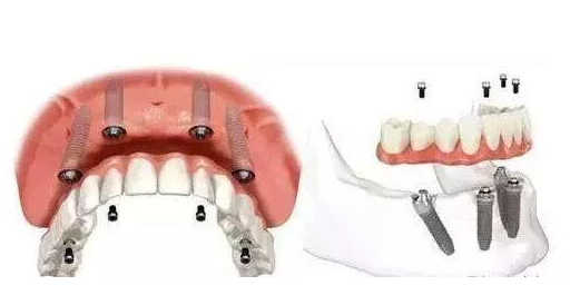 种植体种植牙是什么材料？