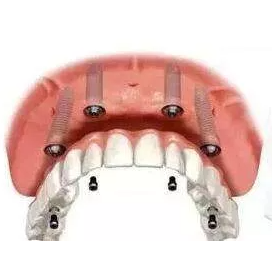 杭州种植牙按颗数收费的吗？