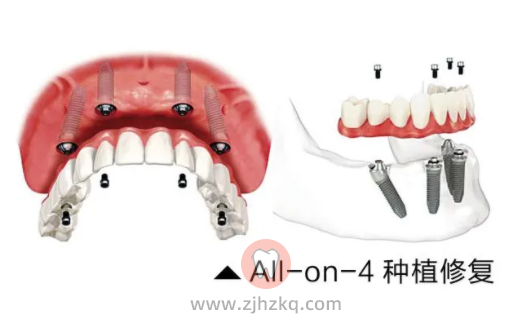 杭州种植牙价格为啥医院差价这么大？