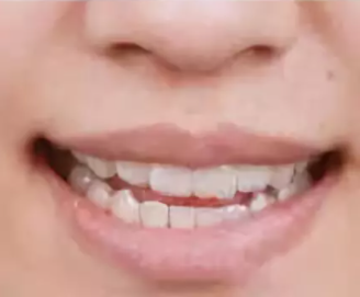 杭州无托槽隐形牙套价格表