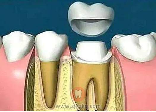 杭州根管治疗牙冠费用