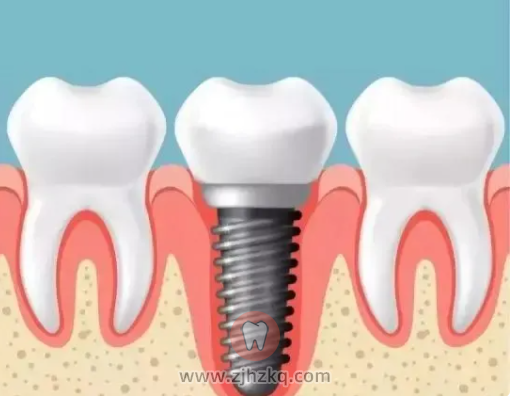 杭州种牙种植体价格对比