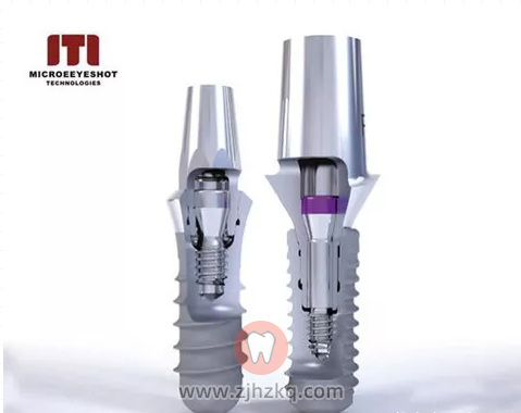 杭州瑞士iti种植牙费用价格表