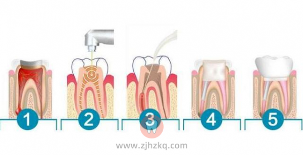 什么是根管治疗