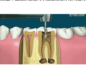 根管治疗疼不疼？
