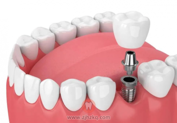 千万不要种植牙是真的吗？