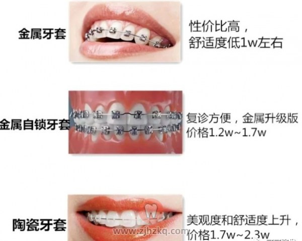 杭州牙套价格一般是多少钱一个？