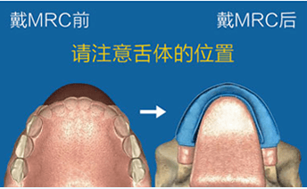 杭州儿童早期矫治MRC肌功能正畸