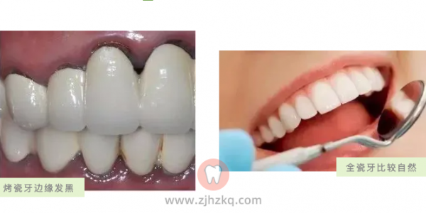 全瓷牙烤瓷牙区别