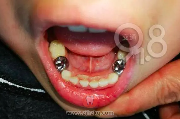杭州儿童双排牙齿看牙记