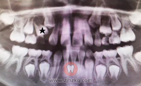 杭州儿童双排牙齿看牙记