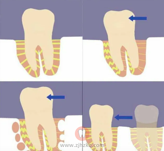 牙齿矫正后松动图片