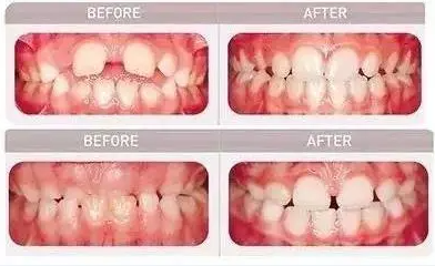 杭州坚果口腔儿童早期矫正中心