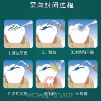 窝沟封闭过程图片