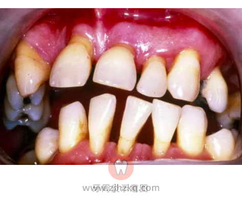 牙龈萎缩图片