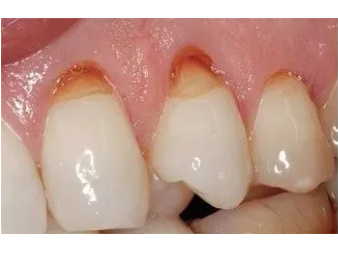 牙齿楔状缺损图片