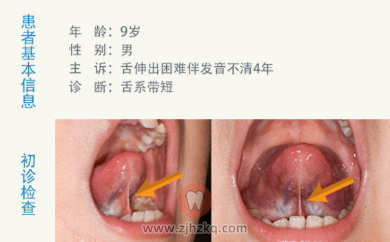 杭州儿童舌系带修整术案例