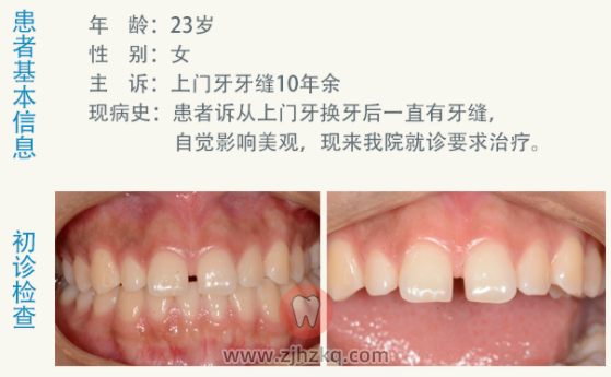 杭州瓷贴面修复上切牙案例