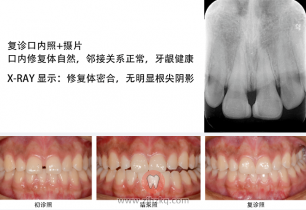 杭州瓷贴面修复上切牙案例