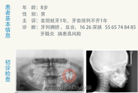 杭州儿童早期矫正地包天反颌案例