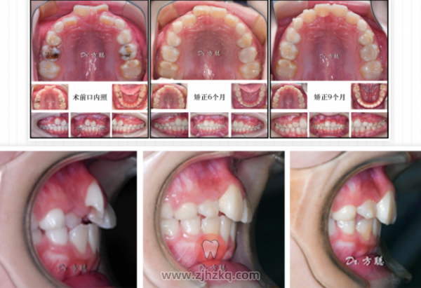 杭州儿童早期矫正地包天反颌案例