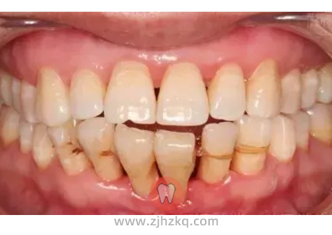 牙龈萎缩症状图片