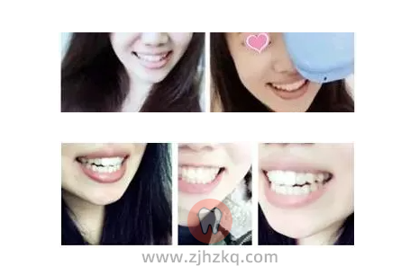 杭州不带牙套整牙案例
