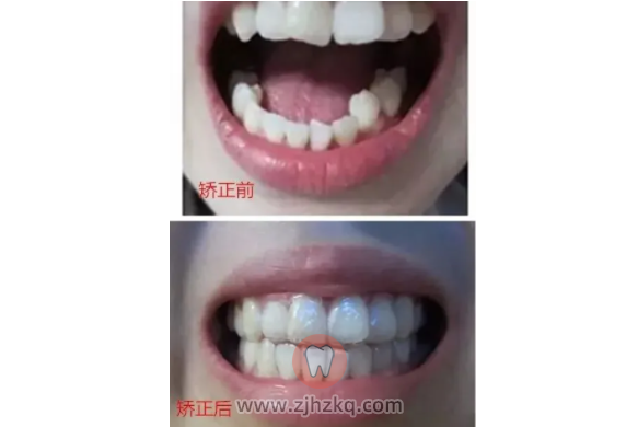 杭州不带牙套整牙案例