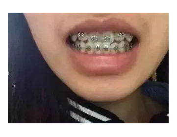 杭州金属牙套矫牙案例