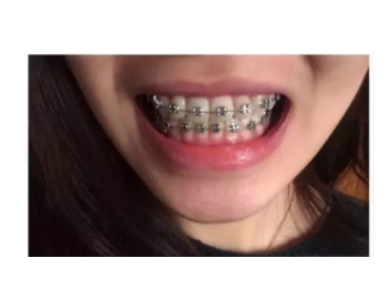 杭州金属牙套矫牙案例