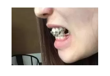 杭州金属牙套矫牙案例