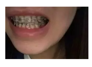 杭州金属牙套矫牙案例