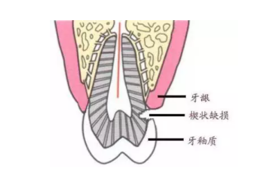 楔状缺损原因到底是什么？