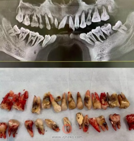 牙周炎到底有多可怕？