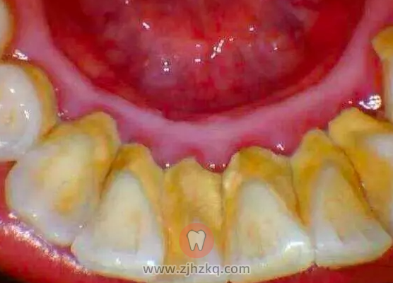 牙周炎是上火导致的吗？