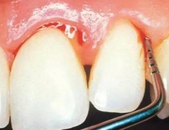 牙周炎吃消炎药管用吗？