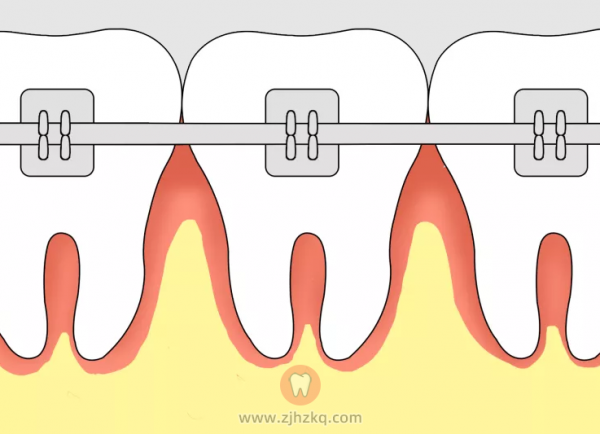 牙齿矫正器就是牙套吗？