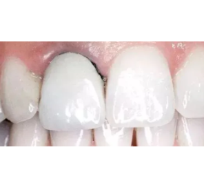 烤瓷牙黑线图片及原因
