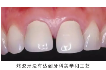 全瓷牙烤瓷牙图片对比