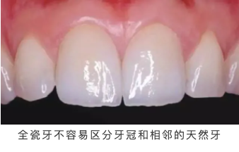 全瓷牙烤瓷牙图片对比