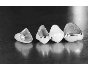 烤瓷牙为什么会发黑？