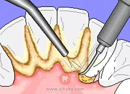 洗牙伤牙吗会把牙齿洗坏掉吗？