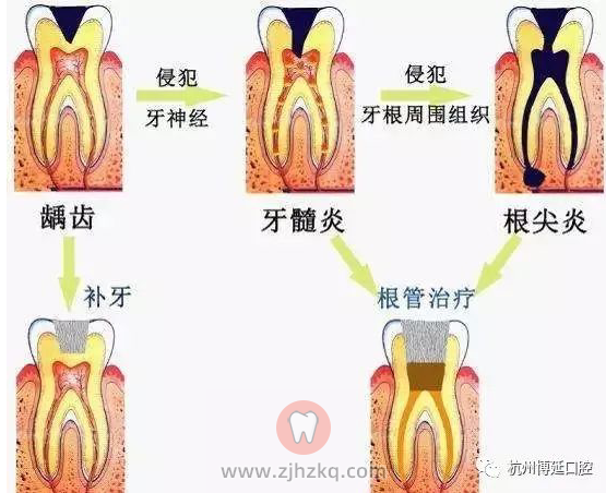 牙髓炎图片
