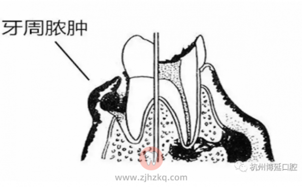 牙周脓肿图片