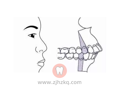 杭州龅牙正畸科普