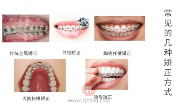 杭州常见的牙齿矫正有哪些？