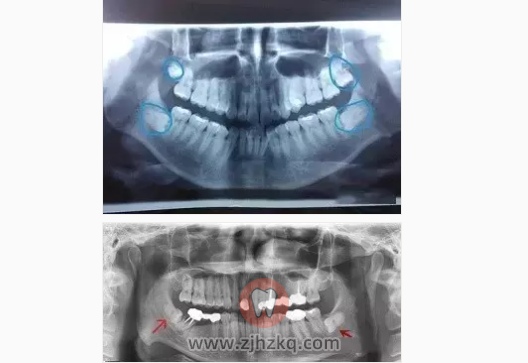 智齿到底是什么牙齿？