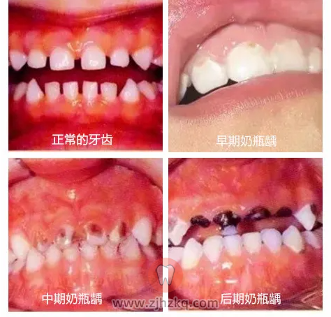 奶瓶龋齿早期中期晚期图片